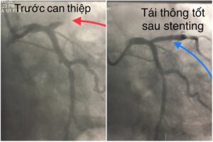 Mạch vành của một trong 10 bệnh nhân trước và sau khi can thiệp đặt stent tái thông máu  /// Ảnh: Đình Tuyển
