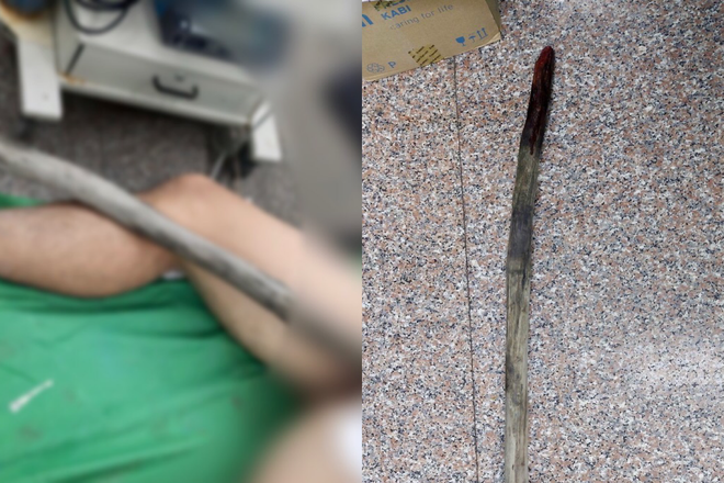 img-9114_nbrn Bệnh nhân đã được đưa vào Bệnh viện Đa khoa Trung ương Cần Thơ cấp cứu cùng cây cọc gỗ đâm xuyên vào người /// Ảnh: Đình Tuyển