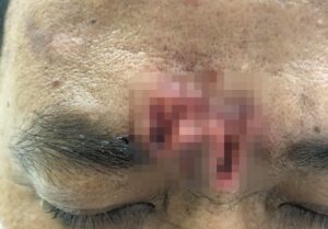 Nam bệnh nhân dùng nhíp "đào bới" tìm con gì bò trên trán khiến trán lở loét, viêm nhiễm /// Ảnh: BVCC