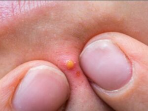 Sau khi nặn mụn, vết mụn của ông Trần bị nhiễm trùng, gây sưng đỏ và rất đau /// Ảnh minh họa: Shutterstock