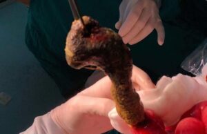 Búi tóc lấy ra từ ruột bé gái /// ẢNH: BVCC