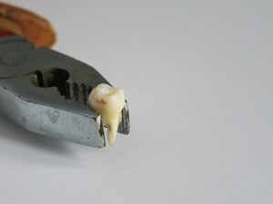 Anh Nitish Kumar ở Ấn Độ đã phẫu thuật để lấy ra 82 chiếc răng từ khối u quanh hàm  /// Ảnh minh họa: Shutterstock