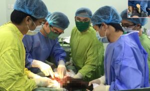 Ê kíp bác sĩ nhiều chuyên khoa đã phối hợp mổ lấy cọc bần ra khỏi cơ thể bệnh nhân /// Đình Tuyển
