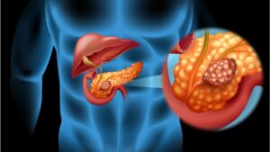 Hầu như tất cả những người mắc ung thư tuyến tụy đều không thể cứu được. Tỷ lệ sống sót sau 5 năm chỉ khoảng 7% /// Shutterstock