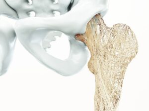 Các bác sĩ Ấn Độ phát hiện 3 bệnh nhân bị hoại tử xương được cho là di chứng của Covid-19  /// Ảnh: Shutterstock