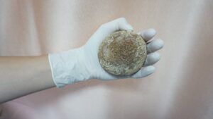 Viên sỏi lấy ra từ bàng quang người đàn ông  /// Ảnh: BVCC